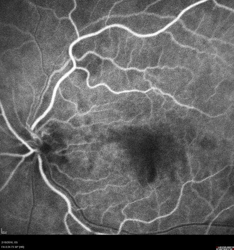 Pattern dystrophy with progressive foveal atrophy left eye
72 year old man.  Vision in the left eye is 20/80.  It declined to 5/200 over about 3 years.

