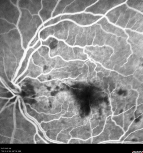 Pattern dystrophy with progressive foveal atrophy left eye
72 year old man.  Vision in the left eye is 20/80.  It declined to 5/200 over about 3 years.
