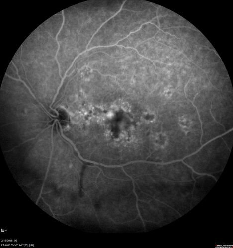 Pattern dystrophy with progressive foveal atrophy left eye
72 year old man.  Vision in the left eye is 20/80.  It declined to 5/200 over about 3 years.
