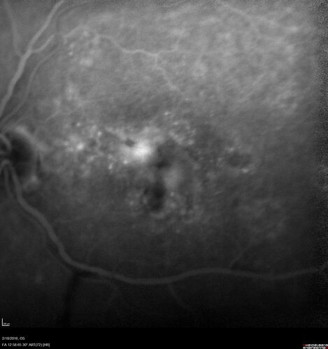 Pattern dystrophy with progressive foveal atrophy left eye
72 year old man.  Vision in the left eye is 20/80.  It declined to 5/200 over about 3 years.
