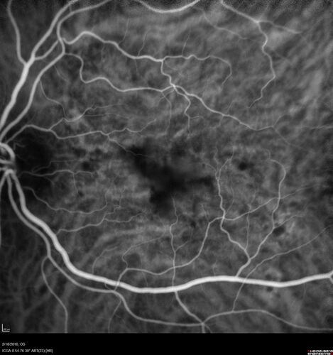 Pattern dystrophy with progressive foveal atrophy left eye
72 year old man.  Vision in the left eye is 20/80.  It declined to 5/200 over about 3 years.
