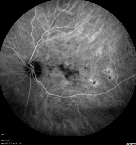 Pattern dystrophy with progressive foveal atrophy left eye
72 year old man.  Vision in the left eye is 20/80.  It declined to 5/200 over about 3 years.
