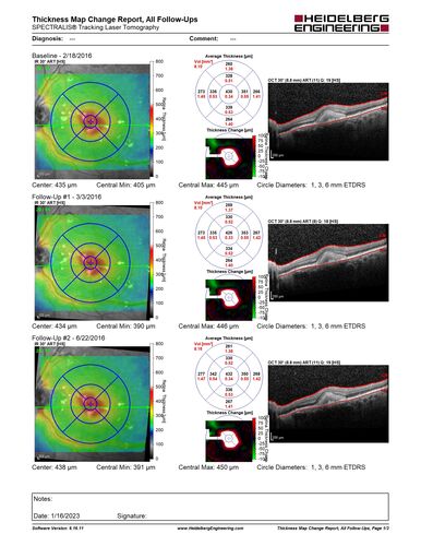 Pattern dystrophy with progressive foveal atrophy left eye
72 year old man.  Vision in the left eye is 20/80.  It declined to 5/200 over about 3 years.

