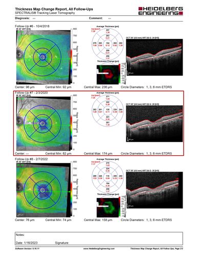Pattern dystrophy with progressive foveal atrophy left eye
72 year old man.  Vision in the left eye is 20/80.  It declined to 5/200 over about 3 years.
