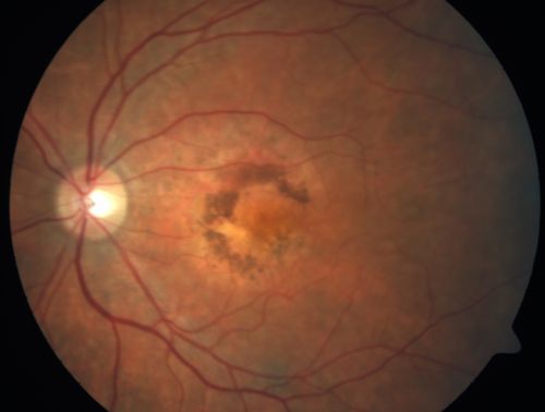Patterned Pigment Dystrophy of the Fovea 2 years later VA still good
