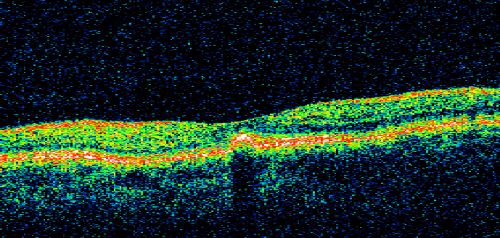 Pattern Dystrophy - Adult Vitelliform - Both Eyes
60-year-old woman noticing less distortion and less blind spots.
OD is 20/20, OS is 20/40
