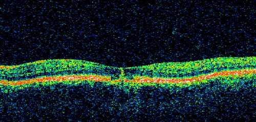 Pattern Dystrophy - Adult Vitelliform - Both Eyes
60-year-old woman noticing less distortion and less blind spots.
OD is 20/20, OS is 20/40
