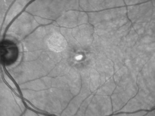 Pattern Dystrophy - Adult Vitelliform - 95 Year Old Man with Good Vision
95-year-old man in excellent health and he doesnâ€™t notice a vision problem.   OD 20/32,  OS 20/80
