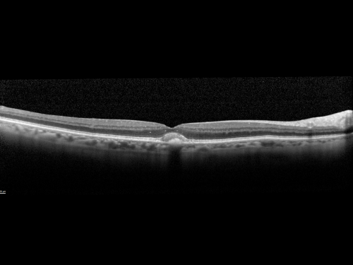 Pattern Dystrophy - Adult Vitelliform - 95 Year Old Man with Good Vision
95-year-old man in excellent health and he doesnâ€™t notice a vision problem.   OD 20/32,  OS 20/80
