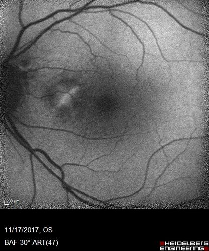 Pattern Dystrophy - Adult Vitellifrom (Best)
71 year old female - lesions nasal to the fovea in both eyes. (20/40 OU)
