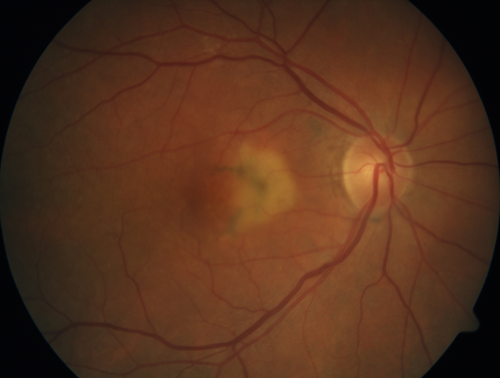 Pattern Dystrophy - Adult Vitellifrom (Best)
71 year old female - lesions nasal to the fovea in both eyes. (20/40 OU)
