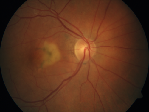 Pattern Dystrophy - Adult Vitellifrom (Best)
71 year old female - lesions nasal to the fovea in both eyes. (20/40 OU)
