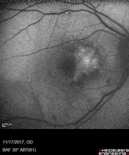 Pattern Dystrophy - Adult Vitellifrom (Best)
71 year old female - lesions nasal to the fovea in both eyes. (20/40 OU)
