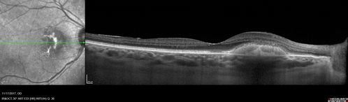 Pattern Dystrophy - Adult Vitellifrom (Best)
71 year old female - lesions nasal to the fovea in both eyes. (20/40 OU)
