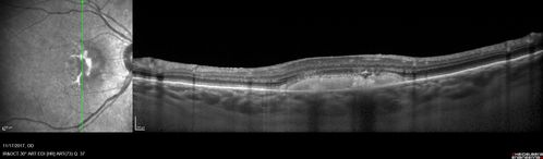 Pattern Dystrophy - Adult Vitellifrom (Best)
71 year old female - lesions nasal to the fovea in both eyes. (20/40 OU)
