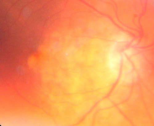 Pattern Dystrophy - Congenital Deafness - Diabetes - Developmental Delay - Macula Right Eye Yellow Submacular Deposits
45-year-old woman congenitally deaf. She has diabetes for the last two years.  She also has developed mental delay and memory problems.  OD 20/200, OS 20/50.   She has sluggish pupillary responses in both eyes.  

Keywords: unkown;dystrophy;deaf