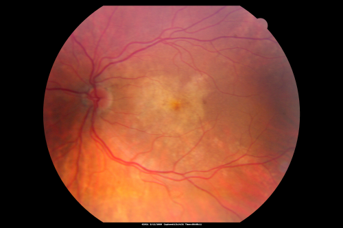 Pattern Dystrophy - Congenital Deafness - Diabetes - Developmental Delay - Color Fundus Photo Left Eye
45-year-old woman congenitally deaf. She has diabetes for the last two years.  She also has developed mental delay and memory problems.  OD 20/200, OS 20/50.   She has sluggish pupillary responses in both eyes.  

Keywords: unkown;dystrophy;deaf