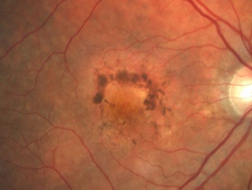 Patterned Pigment Dystrophy of the Fovea 79 YO Woman VA 20/20 Right 20/30 Left
