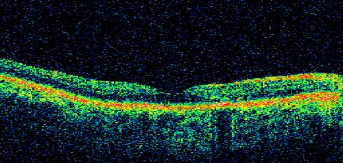 Patterned Pigment Dystrophy of the Fovea 79 YO Woman VA 20/20 Right 20/30 Left

