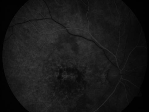 Patterned Pigment Dystrophy of the Fovea 79 YO Woman VA 20/20 Right 20/30 Left
