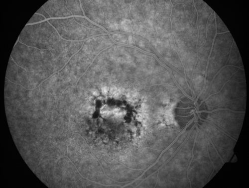 Patterned Pigment Dystrophy of the Fovea 79 YO Woman VA 20/20 Right 20/30 Left
