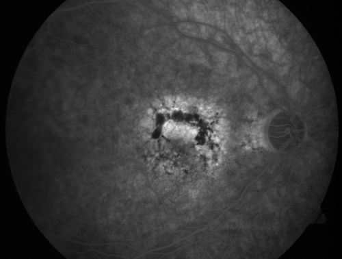 Patterned Pigment Dystrophy of the Fovea 79 YO Woman VA 20/20 Right 20/30 Left

