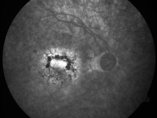 Patterned Pigment Dystrophy of the Fovea 79 YO Woman VA 20/20 Right 20/30 Left
