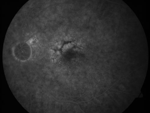 Patterned Pigment Dystrophy of the Fovea 79 YO Woman VA 20/20 Right 20/30 Left
