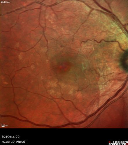 Polypoidal Choroidal Vasculopathy - Right Eye
83 year old female presented in June 2013 with vision loss for 3 months.  She had 2 injections elsewhere with no improvement (avastin).  The first images show a peripapillary CNVM with polyps.  I treated her once with PDT and she stayed dry with good vision for 5 years (2019).  VA on presentation 20/80 OD.  Improved to 20/40
