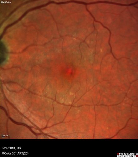 Polypoidal Choroidal Vasculopathy - Right Eye
83 year old female presented in June 2013 with vision loss for 3 months.  She had 2 injections elsewhere with no improvement (avastin).  The first images show a peripapillary CNVM with polyps.  I treated her once with PDT and she stayed dry with good vision for 5 years (2019).  VA on presentation 20/80 OD.  Improved to 20/40
