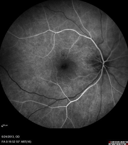 Polypoidal Choroidal Vasculopathy - Right Eye
83 year old female presented in June 2013 with vision loss for 3 months.  She had 2 injections elsewhere with no improvement (avastin).  The first images show a peripapillary CNVM with polyps.  I treated her once with PDT and she stayed dry with good vision for 5 years (2019).  VA on presentation 20/80 OD.  Improved to 20/40
