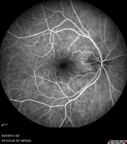 Polypoidal Choroidal Vasculopathy - Right Eye
83 year old female presented in June 2013 with vision loss for 3 months.  She had 2 injections elsewhere with no improvement (avastin).  The first images show a peripapillary CNVM with polyps.  I treated her once with PDT and she stayed dry with good vision for 5 years (2019).  VA on presentation 20/80 OD.  Improved to 20/40
