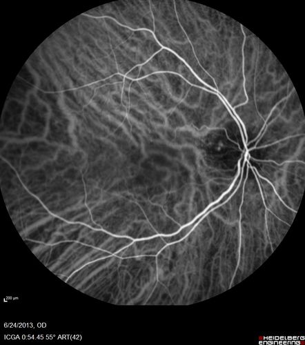 Polypoidal Choroidal Vasculopathy - Right Eye
83 year old female presented in June 2013 with vision loss for 3 months.  She had 2 injections elsewhere with no improvement (avastin).  The first images show a peripapillary CNVM with polyps.  I treated her once with PDT and she stayed dry with good vision for 5 years (2019).  VA on presentation 20/80 OD.  Improved to 20/40
