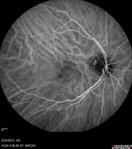 Polypoidal Choroidal Vasculopathy - Right Eye
83 year old female presented in June 2013 with vision loss for 3 months.  She had 2 injections elsewhere with no improvement (avastin).  The first images show a peripapillary CNVM with polyps.  I treated her once with PDT and she stayed dry with good vision for 5 years (2019).  VA on presentation 20/80 OD.  Improved to 20/40
