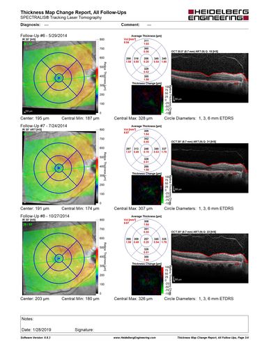 Polypoidal Choroidal Vasculopathy - Right Eye
83 year old female presented in June 2013 with vision loss for 3 months.  She had 2 injections elsewhere with no improvement (avastin).  The first images show a peripapillary CNVM with polyps.  I treated her once with PDT and she stayed dry with good vision for 5 years (2019).  VA on presentation 20/80 OD.  Improved to 20/40
