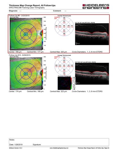 Polypoidal Choroidal Vasculopathy - Right Eye
83 year old female presented in June 2013 with vision loss for 3 months.  She had 2 injections elsewhere with no improvement (avastin).  The first images show a peripapillary CNVM with polyps.  I treated her once with PDT and she stayed dry with good vision for 5 years (2019).  VA on presentation 20/80 OD.  Improved to 20/40
