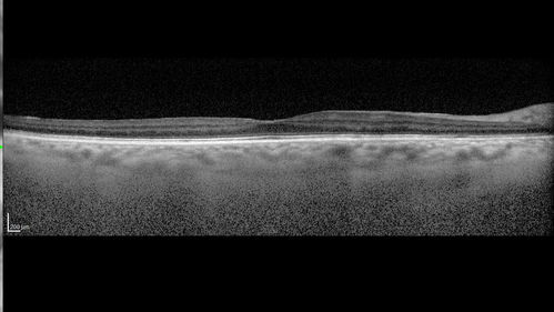 Polypiodal Choroidal Vasculopathy - Temporal Macula - Left eye
82 year old man with asymptomatic PCV in the left eye.  Vision 20/50 OD, 20/32 OS  did well with Lucentis
