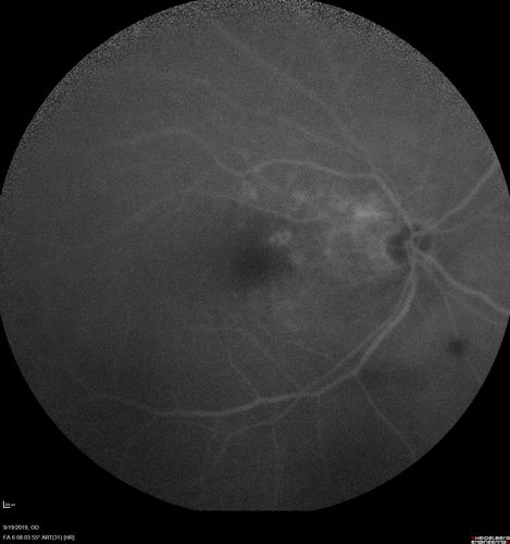 Polypiodal Choroidal Vasculopathy - Temporal Macula - Left eye
82 year old man with asymptomatic PCV in the left eye.  Vision 20/50 OD, 20/32 OS  did well with Lucentis
