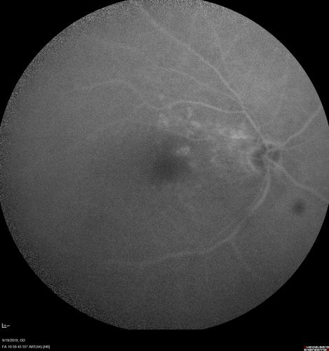Polypiodal Choroidal Vasculopathy - Temporal Macula - Left eye
82 year old man with asymptomatic PCV in the left eye.  Vision 20/50 OD, 20/32 OS  did well with Lucentis
