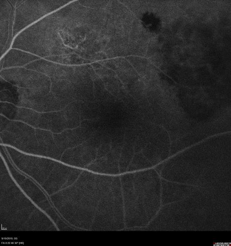 Polypiodal Choroidal Vasculopathy - Temporal Macula - Left eye
82 year old man with asymptomatic PCV in the left eye.  Vision 20/50 OD, 20/32 OS  did well with Lucentis
