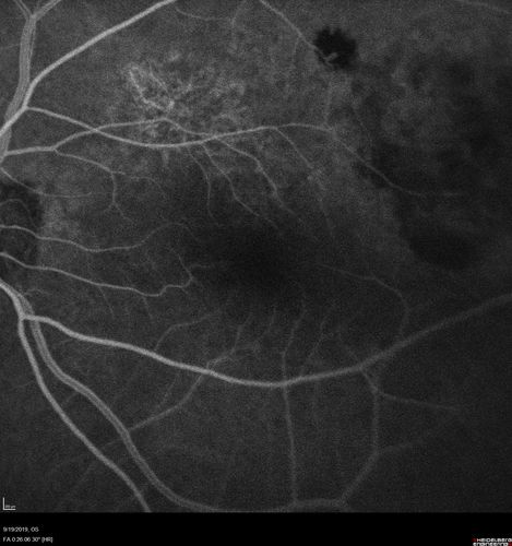 Polypiodal Choroidal Vasculopathy - Temporal Macula - Left eye
82 year old man with asymptomatic PCV in the left eye.  Vision 20/50 OD, 20/32 OS  did well with Lucentis
