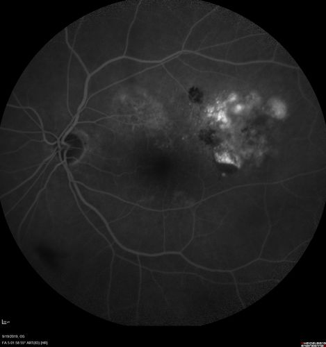Polypiodal Choroidal Vasculopathy - Temporal Macula - Left eye
82 year old man with asymptomatic PCV in the left eye.  Vision 20/50 OD, 20/32 OS  did well with Lucentis
