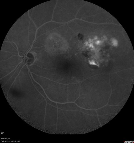 Polypiodal Choroidal Vasculopathy - Temporal Macula - Left eye
82 year old man with asymptomatic PCV in the left eye.  Vision 20/50 OD, 20/32 OS  did well with Lucentis
