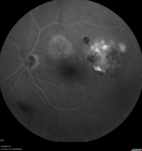 Polypiodal Choroidal Vasculopathy - Temporal Macula - Left eye
82 year old man with asymptomatic PCV in the left eye.  Vision 20/50 OD, 20/32 OS  did well with Lucentis

