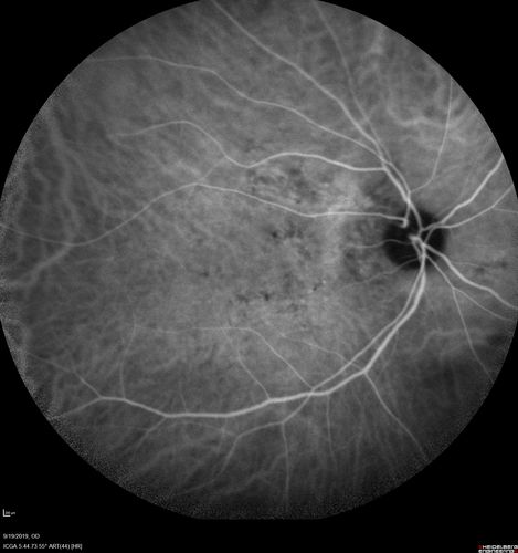 Polypiodal Choroidal Vasculopathy - Temporal Macula - Left eye
82 year old man with asymptomatic PCV in the left eye.  Vision 20/50 OD, 20/32 OS  did well with Lucentis
