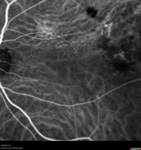 Polypiodal Choroidal Vasculopathy - Temporal Macula - Left eye
82 year old man with asymptomatic PCV in the left eye.  Vision 20/50 OD, 20/32 OS  did well with Lucentis
