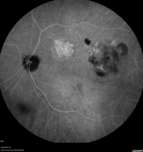Polypiodal Choroidal Vasculopathy - Temporal Macula - Left eye
82 year old man with asymptomatic PCV in the left eye.  Vision 20/50 OD, 20/32 OS  did well with Lucentis
