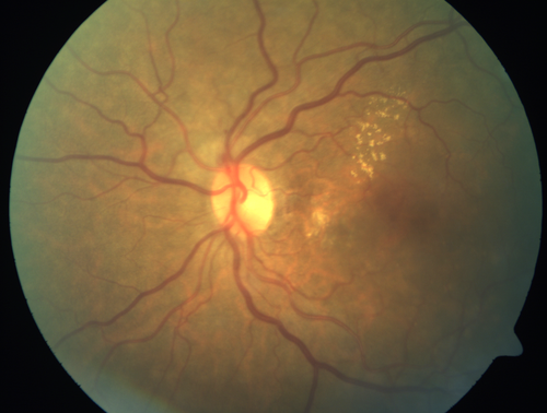 Polypoidal Choroidal Vasculopathy with Pulsating ICG polyp left eye
