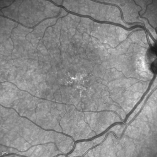 Polypoidal Choroidal Vasculopathy with Pulsating ICG polyp left eye
