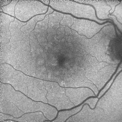 Polypoidal Choroidal Vasculopathy with Pulsating ICG polyp left eye
